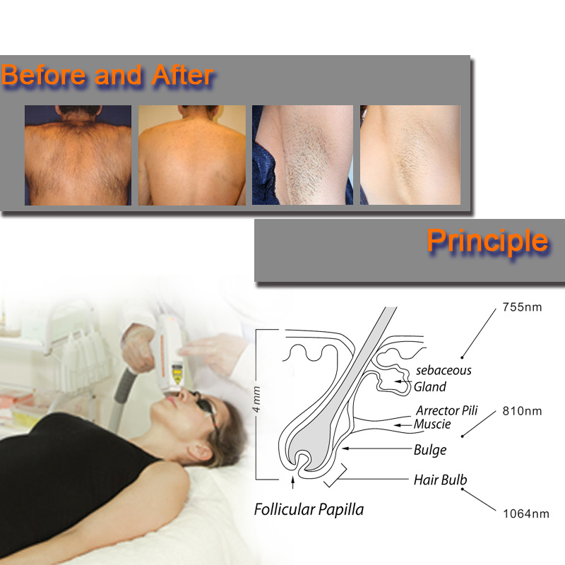 M&aacute;quina de laser de diodo 8101