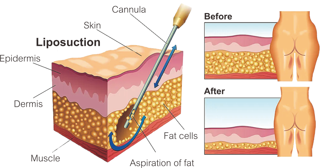 Pe&ccedil;a de m&atilde;o para lip&oacute;lise a laser 