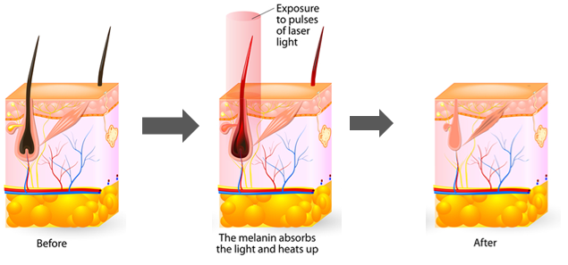 Princ&iacute;pio da m&aacute;quina a laser de diodo 810nm