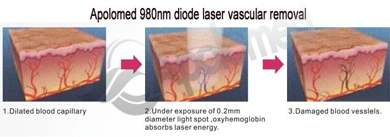 laser de diodo 980nm vascular