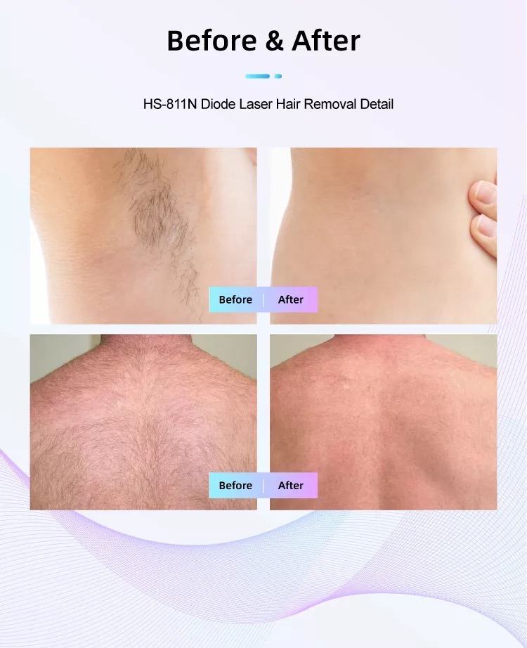 F&aacute;brica de m&aacute;quinas de depila&ccedil;&atilde;o a laser de diodo HS-811