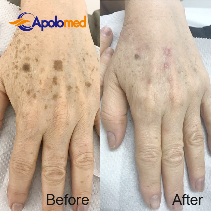 M&aacute;quina Q-Swithced Nd YAG Laser antes depois