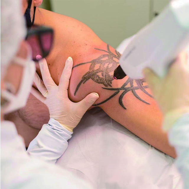 Por que a remoção a laser de tatuagem é tão cara?