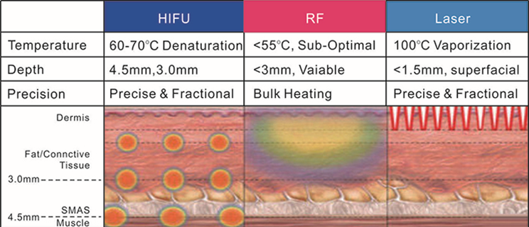 Princ&iacute;pio HIFU