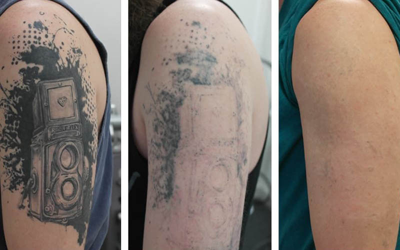 O que dói mais: remoção de tatuagem a laser ou remoção de cabelo a laser?