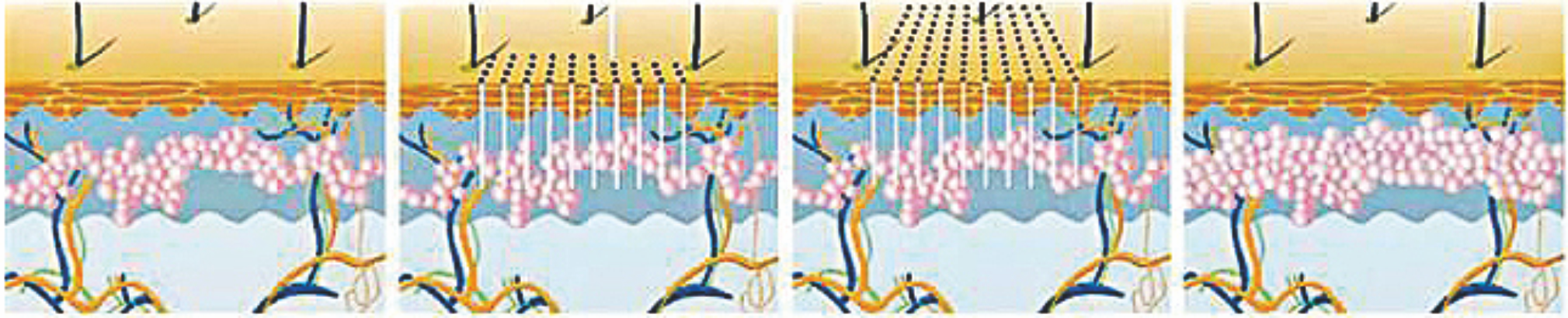 Laser de fibra de &eacute;rbio 1550 nm ---- Remodela&ccedil;&atilde;o profunda