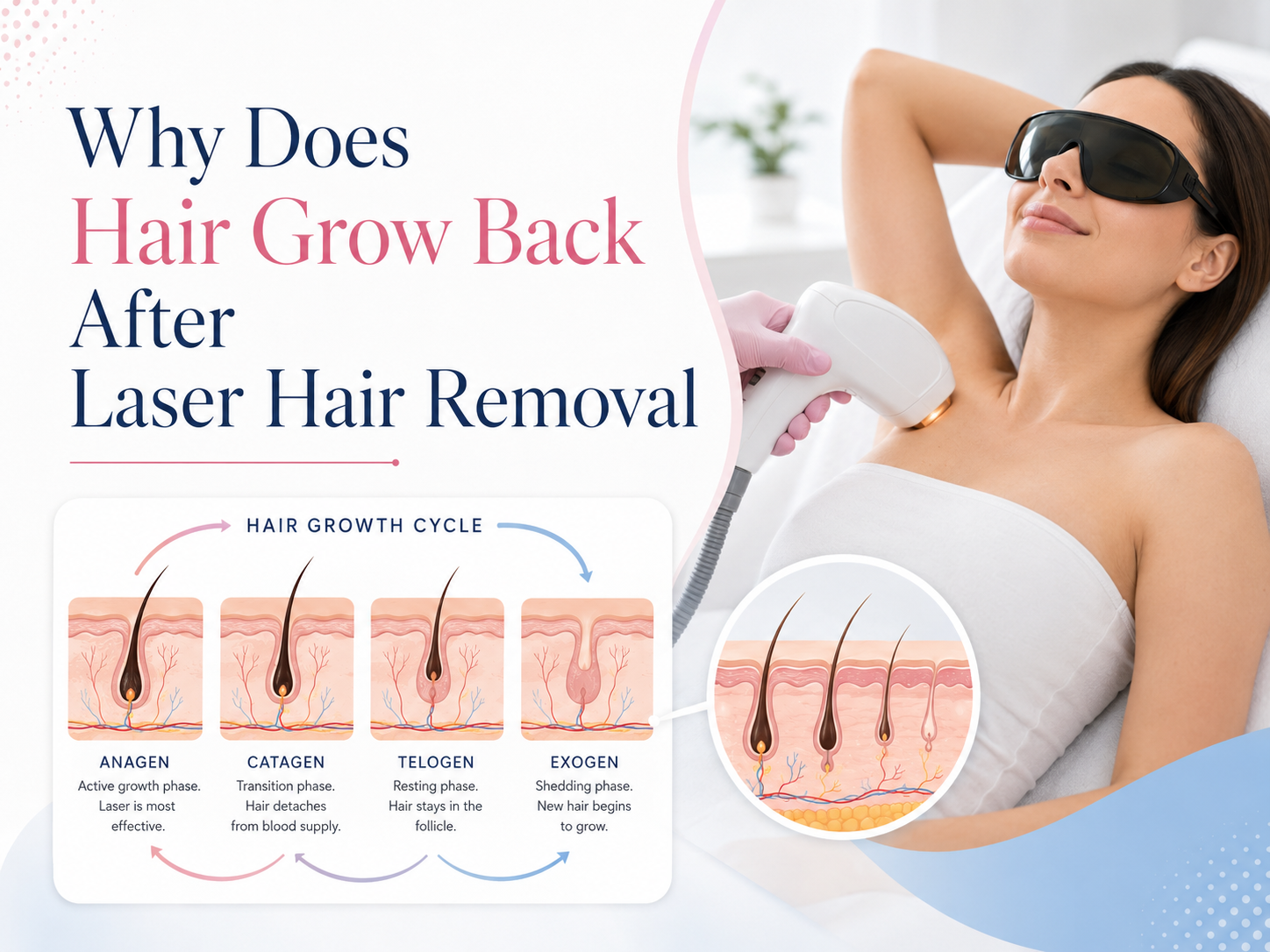 Por que o cabelo volta a crescer após a depilação a laser?